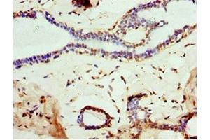Immunohistochemistry of paraffin-embedded human breast cancer using ABIN7160457 at dilution of 1:100 (MOG 抗体  (AA 30-154))