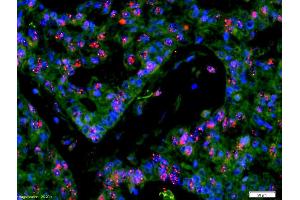 Formalin-fixed and paraffin-embedded human rectal carcinoma labeled with Anti-CDCA5/Sororin Polyclonal Antibody, Unconjugated (ABIN872622) 1:200, overnight at 4°C, The secondary antibody was Goat Anti-Rabbit IgG, Cy3 conjugated used at 1:200 dilution for 40 minutes at 37°C. (CDCA5 抗体  (AA 101-200))