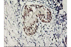 Immunohistochemical staining of paraffin-embedded Adenocarcinoma of Human breast tissue using anti-SERPINB13 mouse monoclonal antibody. (SERPINB13 抗体)