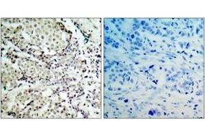 Immunohistochemistry analysis of paraffin-embedded human breast carcinoma tissue, using MKK6 (Ab-207) Antibody. (MAP2K6 抗体  (AA 173-222))