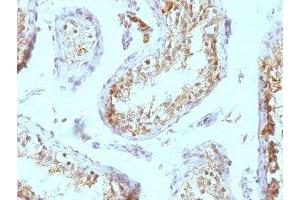 Formalin-fixed, paraffin-embedded human testicular carcinoma stained with anti-Perlecan antibody (SPM255). (HSPG2 抗体)