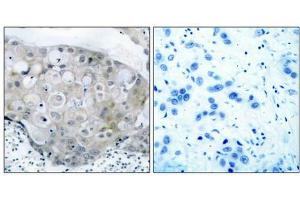 Immunohistochemical analysis of paraffin-embedded human breast carcinoma tissue using VEGFR2(Phospho-Tyr951) Antibody(left) or the same antibody preincubated with blocking peptide(right). (VEGFR2/CD309 抗体  (pTyr951))