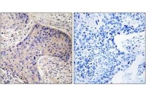 Immunohistochemistry analysis of paraffin-embedded human prostate carcinoma tissue, using ST6GAL1 Antibody. (ST6GAL1 抗体  (AA 171-220))