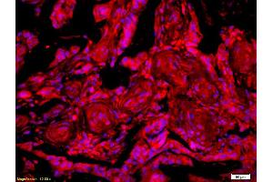 Formalin-fixed and paraffin-embedded human rectal carcinoma labeled with Anti-GTSE-1 Polyclonal Antibody, Unconjugated (ABIN741405) 1:200, overnight at 4°C, The secondary antibody was Goat Anti-Rabbit IgG, Cy3 conjugated used at 1:200 dilution for 40 minutes at 37°C. (GTSE1 抗体  (AA 651-739))