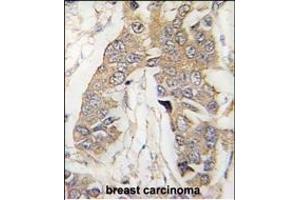 Formalin-fixed and paraffin-embedded human breast carcinoma tissue reacted with CASC3 Antibody (C-term) (ABIN391401 and ABIN2841404) , which was peroxidase-conjugated to the secondary antibody, followed by DAB staining. (CASC3 抗体  (AA 206-236))
