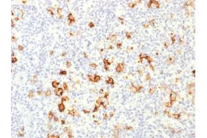 Formalin-fixed, paraffin-embedded human Hodgkin's Lymphoma stained with CD15 Rabbit Polyclonal Antibody. (CD15 抗体)