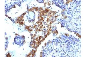 Immunohistochemical staining (Formalin-fixed paraffin-embedded sections) of human lung adenocarcinoma with NAPSA monoclonal antibody, clone NAPSA/1239 .