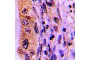 Immunohistochemical analysis of PHLDA3 staining in human lung cancer formalin fixed paraffin embedded tissue section. (PHLDA3 抗体)