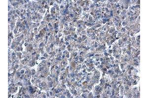 IHC-P Image Heme Oxygenase 1 antibody detects Heme Oxygenase 1 protein at cytoplasm on human renal carcinoma by immunohistochemical analysis.