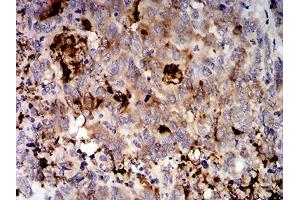 Immunohistochemical analysis of paraffin-embedded stomach cancer tissues using MUC5AC mouse mAb with DAB staining. (MUC5AC 抗体  (AA 5528-5627))
