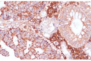 Immunohistochemistry of paraffin-embedded Human colon carcinoma using MZB1 Polyclonal Antibody at dilution of 1:100 (40x lens). (MZB1 抗体)