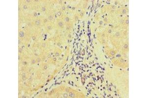 Immunohistochemistry of paraffin-embedded human liver cancer using ABIN7172513 at dilution of 1:100 (E2F1 抗体  (AA 133-362))