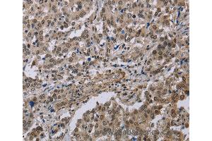 Immunohistochemistry of Human brain  using MGLL Polyclonal Antibody at dilution of 1:40 (MGLL 抗体)