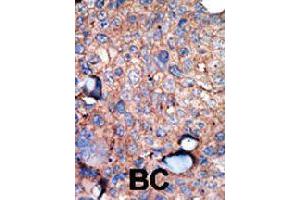Formalin-fixed and paraffin-embedded human breast cancer tissue reacted with IKBKE polyclonal antibody  , which was peroxidase-conjugated to the secondary antibody, followed by AEC staining. (IKKi/IKKe 抗体  (C-Term))
