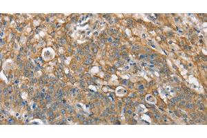 Immunohistochemistry of paraffin-embedded Human gastric cancer tissue using CSMD1 Polyclonal Antibody at dilution 1:40 (CSMD1 抗体)