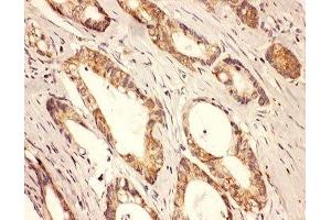 IHC-P: Rab8 antibody testing of human intestine cancer tissue (RAB8A 抗体  (C-Term))
