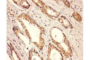 IHC-P: Rab8 antibody testing of human intestine cancer tissue