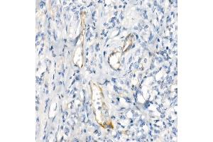 Immunohistochemistry of paraffin-embedded human colon carcinoma using eNOS Rabbit mAb (ABIN7268920) at dilution of 1:200 (40x lens).