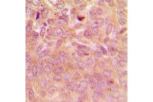Immunohistochemical analysis of Laminin Receptor staining in human breast cancer formalin fixed paraffin embedded tissue section. (RPSA/Laminin Receptor 抗体)