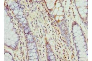 Immunohistochemistry of paraffin-embedded human colon cancer using ABIN7171417 at dilution of 1:100 (CCT5 抗体  (AA 1-270))