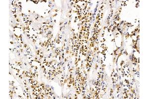 ABIN7094692 and ABIN7098743 at 1/100 staining Human pancreatic cancer by IHC-P. (LMX1A 抗体  (Internal Region))