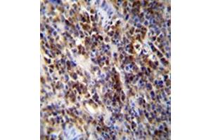 Immunohistochemistry analysis in formalin fixed and paraffin embedded human lymphoma reacted with PAPR9 Antibody (C-term) followed which was peroxidase conjugated to the secondary antibody followed byand DAB staining. (PARP9 抗体  (C-Term))