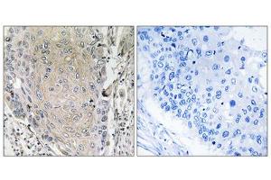 Immunohistochemistry analysis of paraffin-embedded human lung carcinoma tissue using CBLN3 antibody. (CBLN3 抗体  (C-Term))
