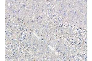 ABIN6256414 and ABIN6267549 at 1/100 staining human glioblastoma by IHC-P.