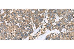 Immunohistochemistry of paraffin-embedded Human liver cancer tissue using EIF1AX Polyclonal Antibody at dilution of 1:65(x200) (EIF1AX 抗体)