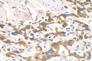 Immunohistochemistry analysis of paraffin-embedded human stomach cancer using MRPL12 (ABIN7074638) at dilution of 1: 1000 (MRPL12 抗体)