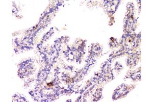Flow cytometry testing of human SiHa cells with Amyloid beta antibody at 1ug/10^6 cells (blocked with goat sera)