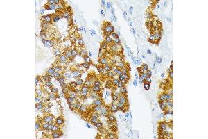 Immunohistochemistry of paraffin-embedded human liver cancer using B3 Rabbit mAb (ABIN7265774) at dilution of 1:100 (40x lens).