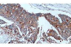 Detection of CTSD in Human Liver cancer Tissue using Monoclonal Antibody to Cathepsin D (CTSD) (Cathepsin D 抗体  (AA 21-412))