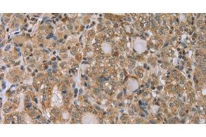 Immunohistochemistry of paraffin-embedded Human thyroid cancer tissue using RAB39B Polyclonal Antibody at dilution 1:45 (RAB39B 抗体)