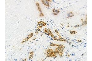 ABIN6262841 and ABIN6274094 at 1/100 staining human pancreatic carcinoma by IHC-P. (KLF11 抗体  (N-Term))