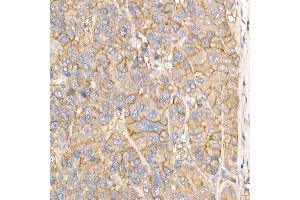 Immunohistochemistry of paraffin-embedded human liver cancer using Na+/K+-ATPase Rabbit pAb (ABIN6133568, ABIN6137299, ABIN6137301 and ABIN6223860) at dilution of 1:50 (40x lens). (ATP1A1 抗体  (AA 1-100))