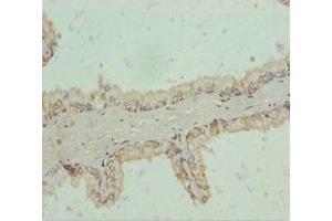 Immunohistochemistry of paraffin-embedded human prostate cancer using ABIN7151192 at dilution of 1:100 (RNF34 抗体  (AA 1-220))
