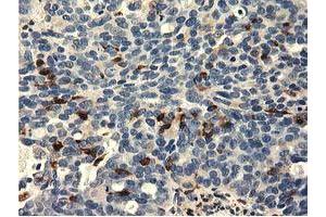 Immunohistochemical staining of paraffin-embedded Adenocarcinoma of Human ovary tissue using anti-MICAL1 mouse monoclonal antibody.