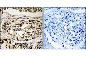 Immunohistochemistry analysis of paraffin-embedded human breast carcinoma, using Cyclin C (Phospho-Ser275) Antibody. (Cyclin C 抗体  (pSer275))