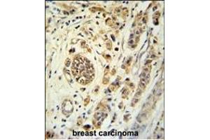 FBXL15 Antibody (C-term) (ABIN651414 and ABIN2840224) immunohistochemistry analysis in formalin fixed and paraffin embedded human breast carcinoma followed by peroxidase conjugation of the secondary antibody and DAB staining. (FBXL15 抗体  (C-Term))