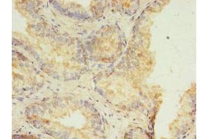 Immunohistochemistry of paraffin-embedded human prostate cancer using ABIN7155196 at dilution of 1:100 (HMGN3 抗体  (AA 1-77))