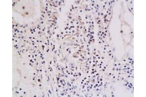 Formalin-fixed and paraffin embedded human oral squamous cell carcinoma labeled with Anti-TNFRSF18 Polyclonal Antibody , Unconjugated at 1:200, followed by conjugation to the secondary antibody and DAB staining (TNFRSF18 抗体  (AA 201-274))