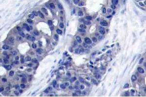 Immunohistochemistry analysis of human breast carcinoma tissue (Formalin-fixed, Paraffin-embedded) using IRS1 antibody . (IRS1 抗体)
