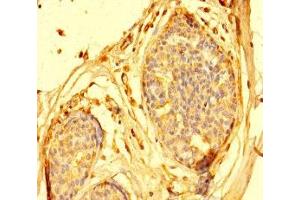 Immunohistochemistry of paraffin-embedded human breast cancer using ABIN7144032 at dilution of 1:100 (AMIGO1 抗体  (AA 28-327))