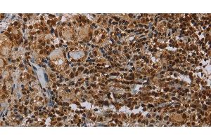 Immunohistochemistry of paraffin-embedded Human thyroid cancer using TBX5 Polyclonal Antibody at dilution of 1:35 (T-Box 5 抗体)