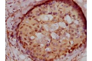 IHC image of ABIN7127675 diluted at 1:100 and staining in paraffin-embedded human breast cancer performed on a Leica BondTM system. (Recombinant PELP1 抗体)