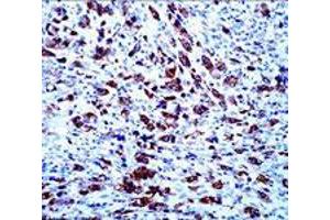 Immunohistochemical staining of APOA5 on paraffin-embedded human anaplastic lymphoma with APOA5 monoclonal antibody, clone 1G5G9 . (APOA5 抗体)