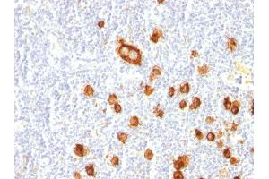 Formalin-fixed, paraffin-embedded human Hodgkin's Lymphoma stained with CD15 Mouse Monoclonal Antibody (FUT4/815). (CD15 抗体)