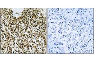 Immunohistochemistry analysis of paraffin-embedded human breast carcinoma tissue, using RPC5 Antibody. (POLR3E 抗体  (AA 191-240))