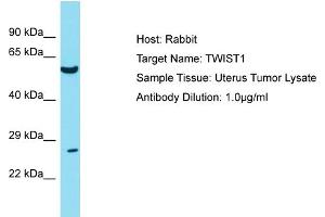 Host: Rabbit Target Name: TWIST1 Sample Tissue: Human Uterus Tumor Antibody Dilution: 1ug/ml (TWIST1 抗体  (N-Term))